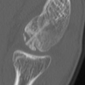 術後CT像（術後1か月）：
関節鏡下で吸収ピンにより病変部を固定
